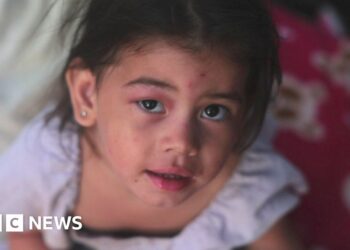 A young girl with a bruised face looks into the camera