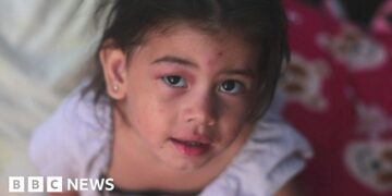 A young girl with a bruised face looks into the camera