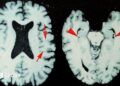 Brain scans of a former NFL player who was diagnosed with CTE