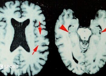 Brain scans of a former NFL player who was diagnosed with CTE