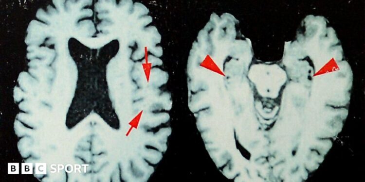 Brain scans of a former NFL player who was diagnosed with CTE
