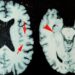 Brain scans of a former NFL player who was diagnosed with CTE
