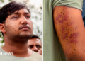 Sahil Lochab's face and right arm which show the pellet gun wounds on his body