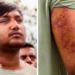 Sahil Lochab's face and right arm which show the pellet gun wounds on his body